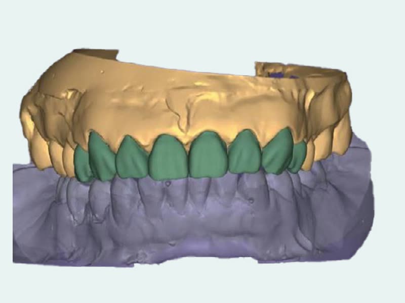Diseño digital CAD de prótesis dental