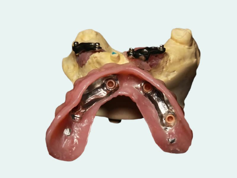Rehabilitación de implantes con estructura metálica
